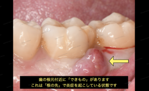 歯茎の白い出来物の腫れの治し方　外科治療　３